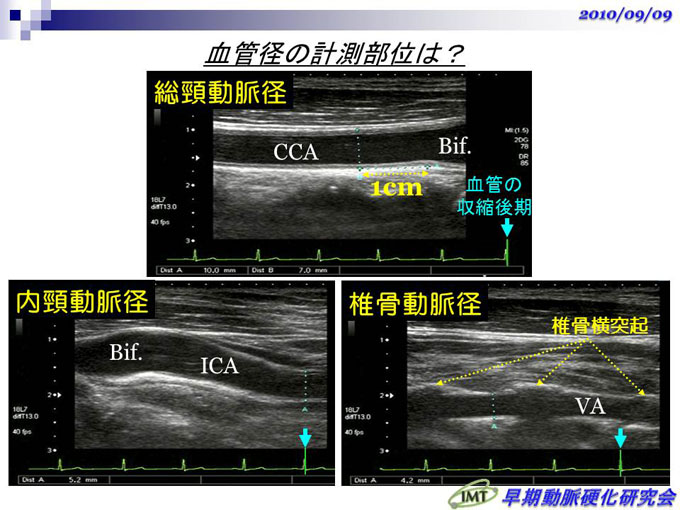 頚動脈エコー 頸動脈エコー | 西宮渡辺心臓脳・血管センター